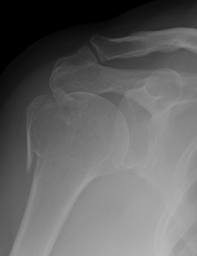 Displaced Greater Tuberosity Fracture AP